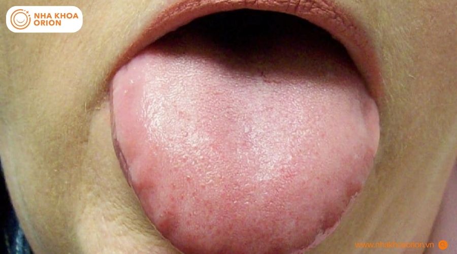 Bề mặt lưỡi hồng h&agrave;i h&ograve;a, kh&ocirc;ng xuất hiện vết lo&eacute;t hay mảng b&aacute;m trắng