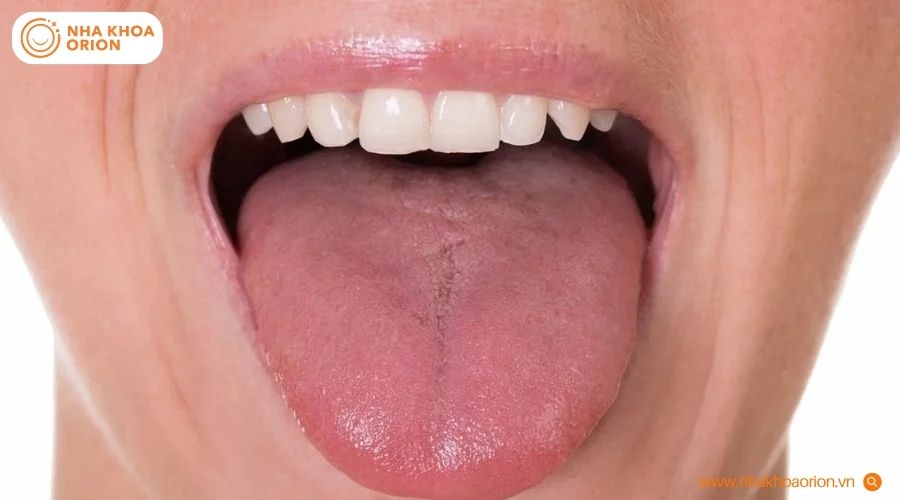 Bề mặt lưỡi hồng h&agrave;i h&ograve;a, kh&ocirc;ng xuất hiện vết lo&eacute;t hay mảng b&aacute;m trắng