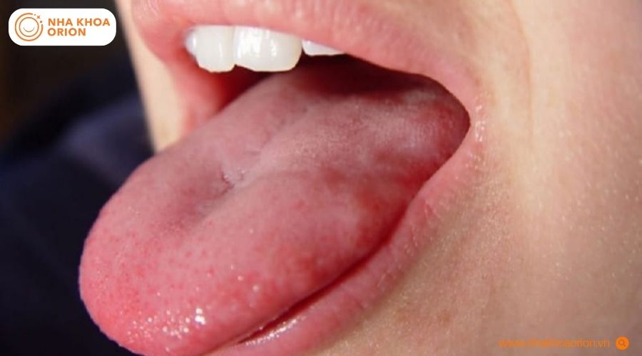 C&aacute;c nh&uacute; gai tr&ecirc;n lưỡi ph&acirc;n bố đều v&agrave; duy tr&igrave; trạng th&aacute;i khỏe mạnh