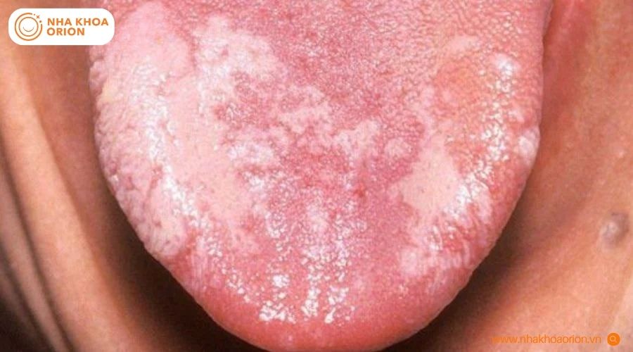 H&igrave;nh ảnh minh họa đặc trưng của t&igrave;nh trạng lưỡi bản đồ