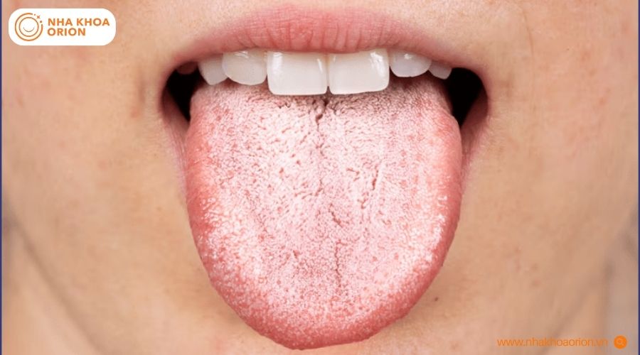 Đốm trắng k&egrave;m sưng vi&ecirc;m c&oacute; thể li&ecirc;n quan đến bệnh bạch sản ở lưỡi