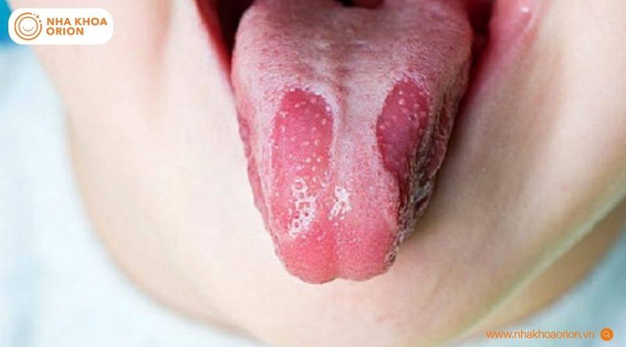 T&igrave;nh trạng nấm lưỡi tiến triển nặng với lớp phủ trắng d&agrave;y