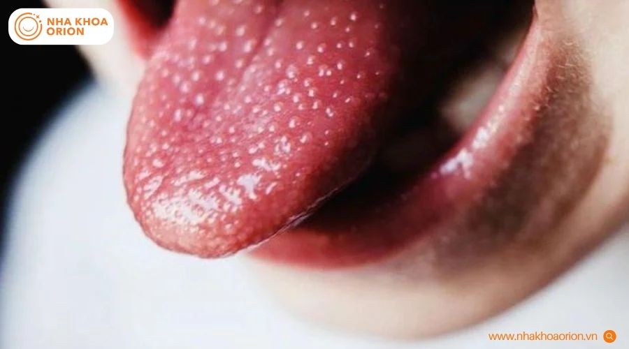 H&igrave;nh ảnh thay đổi ở lưỡi thường gặp khi mắc sốt Scarlet
