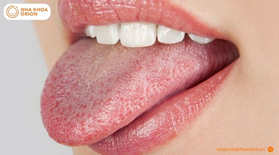 Minh họa tổn thương lưỡi c&oacute; thể gặp ở người nhiễm nấm lưỡi