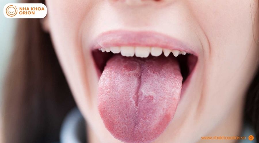 Một số bất thường tr&ecirc;n lưỡi c&oacute; thể li&ecirc;n quan đến t&igrave;nh trạng suy giảm miễn dịch