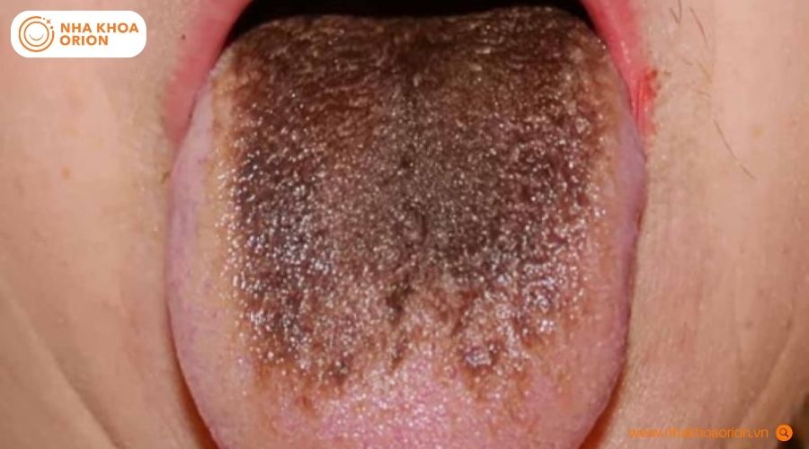 H&igrave;nh ảnh lưỡi xuất hiện mảng đen tr&ecirc;n bề mặt lưỡi