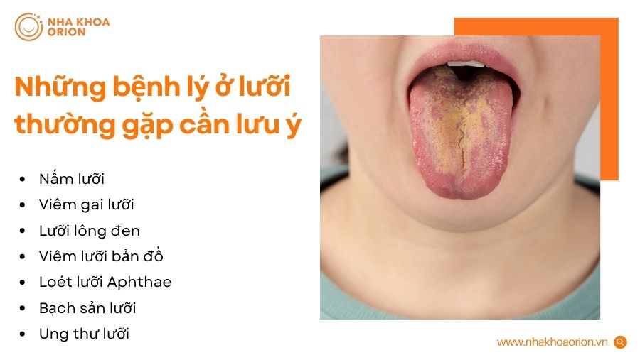 &nbsp;Những bệnh l&yacute; thường gặp ở lưỡi cần lưu &yacute; v&agrave; nhận biết sớm