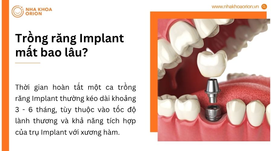 Thời gian trồng răng Implant thường 3-6 th&aacute;ng gồm cấy trụ, t&iacute;ch hợp xương v&agrave; gắn răng sứ