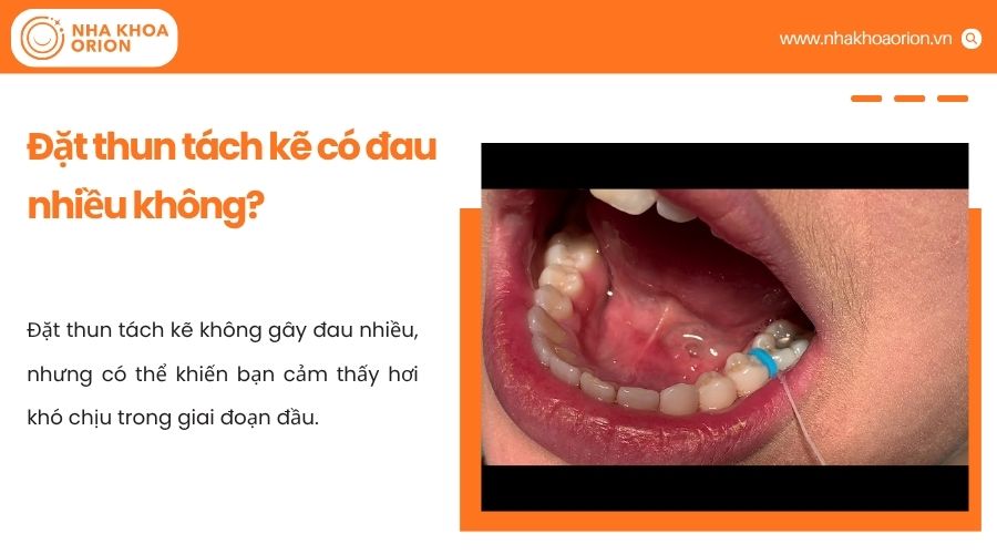 Thun t&aacute;ch kẽ c&oacute; thể g&acirc;y &ecirc; nhẹ ban đầu nhưng kh&ocirc;ng g&acirc;y đau nhiều v&agrave; nhanh hết