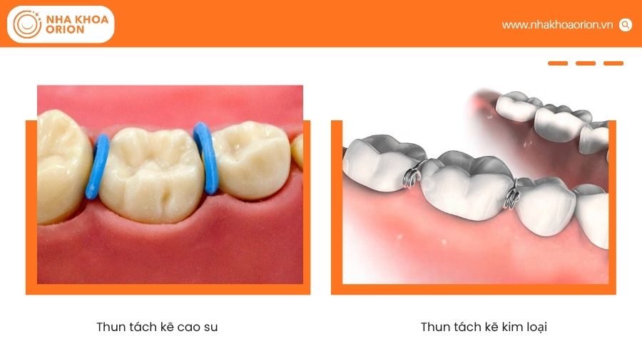 Hai loại thun t&aacute;ch kẽ phổ biến hiện nay l&agrave; thun cao su v&agrave; thun kim loại