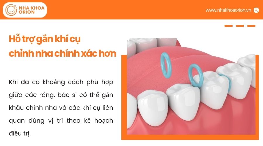Thun t&aacute;ch kẽ gi&uacute;p tạo khoảng trống, hỗ trợ gắn kh&iacute; cụ chỉnh nha ch&iacute;nh x&aacute;c hơn