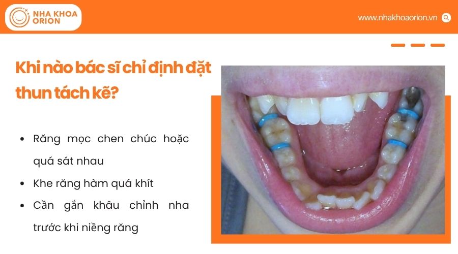 B&aacute;c sĩ sẽ chỉ định đặt thun t&aacute;ch kẽ khi răng chen ch&uacute;c hoặc cần tạo khoảng để gắn kh&acirc;u