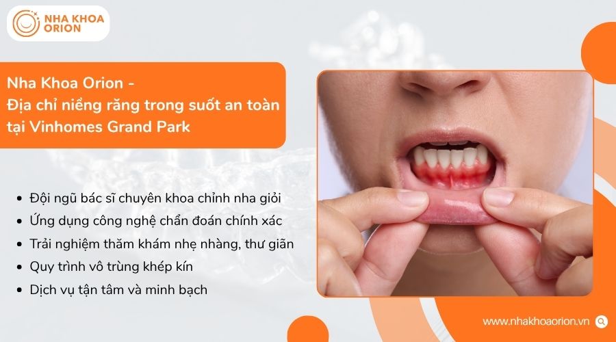Nha khoa Orion l&agrave; địa chỉ niềng răng trong suốt nhẹ nh&agrave;ng, an to&agrave;n với c&ocirc;ng nghệ hiện đại