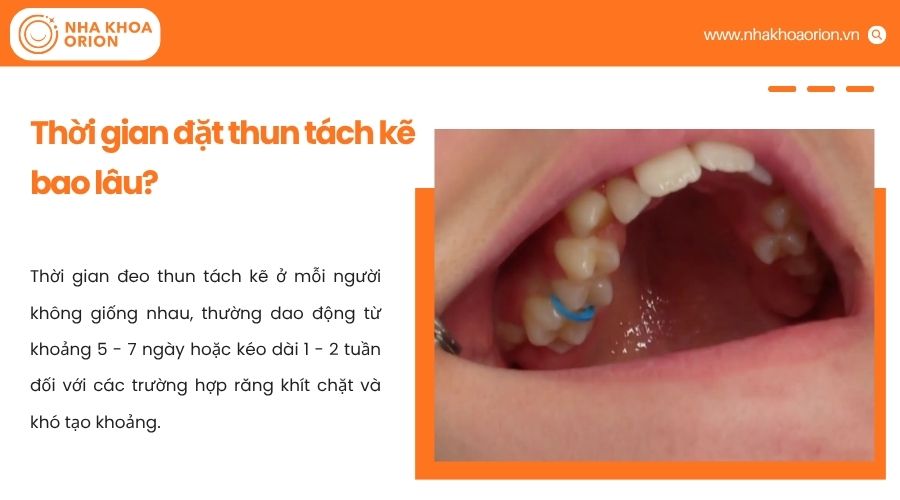 Thời gian đeo thun t&aacute;ch kẽ thường 5 - 7 ng&agrave;y, t&ugrave;y mức độ kh&iacute;t v&agrave; dịch chuyển răng