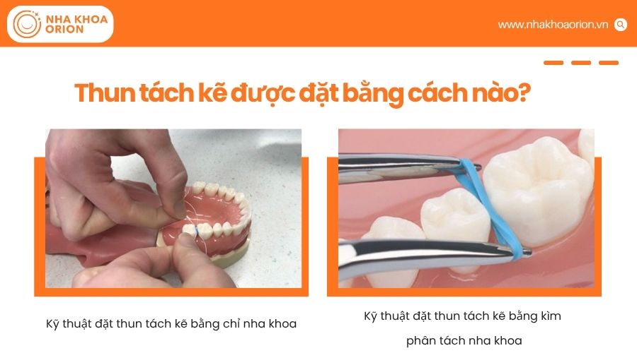 B&aacute;c sĩ đặt thun t&aacute;ch kẽ bằng dụng cụ chuy&ecirc;n dụng để tạo khoảng trống giữa c&aacute;c răng