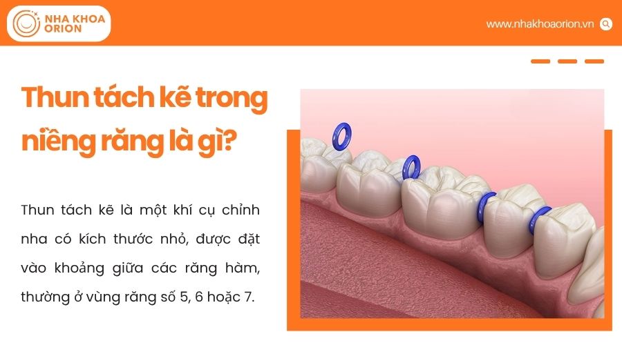 Thun t&aacute;ch kẽ l&agrave; kh&iacute; cụ tạo khoảng trống giữa c&aacute;c răng h&agrave;m trước khi gắn band