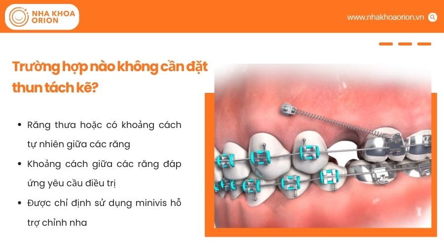 B&aacute;c sĩ sẽ chỉ định đặt thun t&aacute;ch kẽ khi răng chen ch&uacute;c hoặc cần tạo khoảng để gắn kh&acirc;u