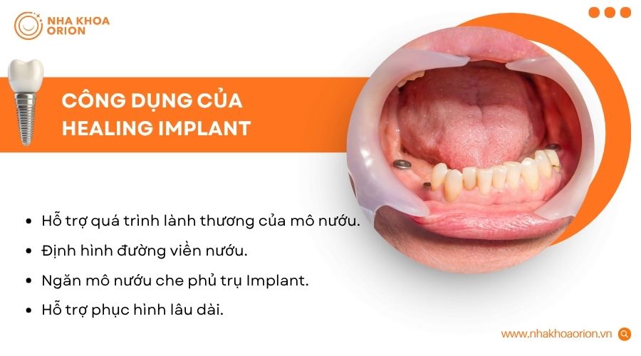 Healing Implant gi&uacute;p m&ocirc; nướu l&agrave;nh thương ổn định v&agrave; hỗ trợ phục h&igrave;nh Implant hiệu quả