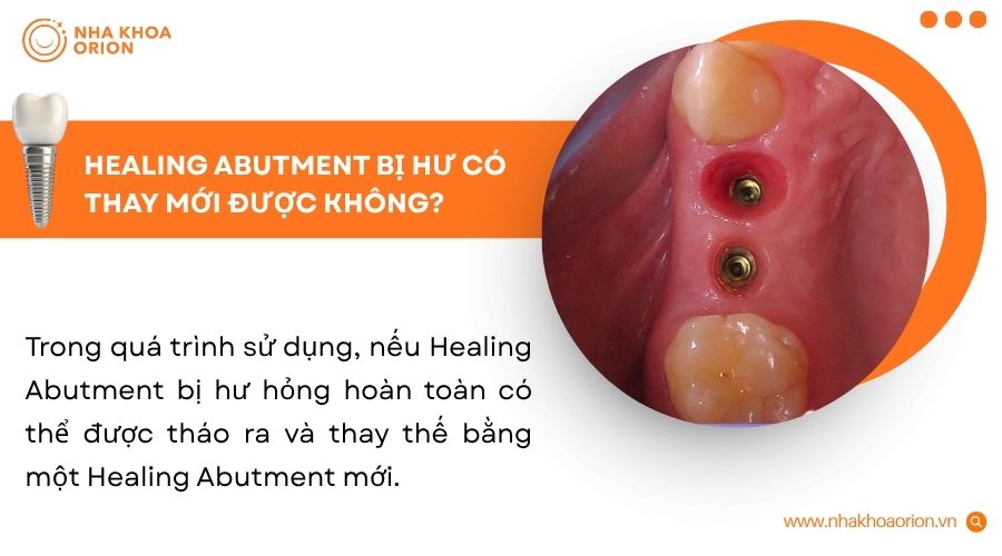 Healing Abutment bị hư c&oacute; thể thay mới nếu được b&aacute;c sĩ kiểm tra đ&uacute;ng c&aacute;ch