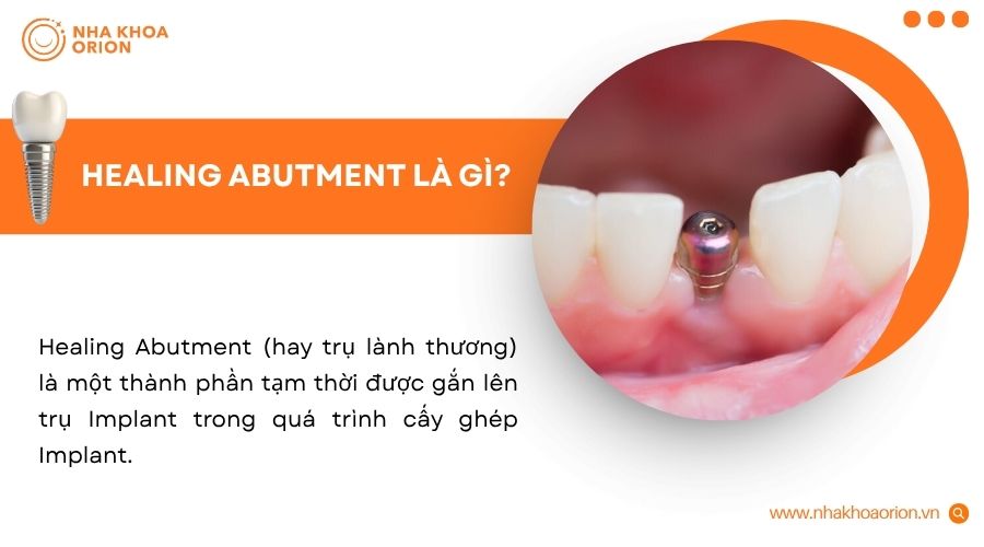 Healing Implant hỗ trợ bảo vệ trụ v&agrave; định h&igrave;nh nướu trước khi phục h&igrave;nh răng sứ