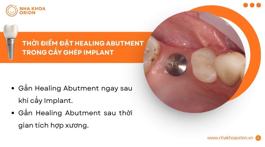 B&aacute;c sĩ sẽ đặt Healing Abutment t&ugrave;y theo độ ổn định của trụ Implant