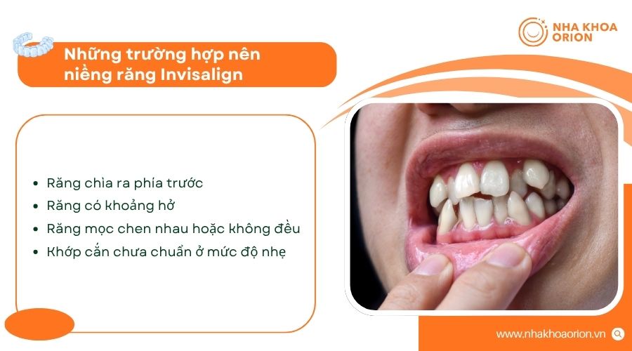 Khay niềng tháo rời giúp vệ sinh răng miệng dễ dàng hơn