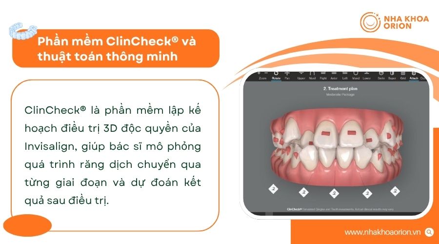 Phần mềm ClinCheck® mô phỏng kết quả chỉnh nha trước điều trị