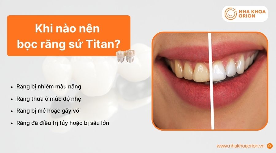 Răng sứ Titan có thể giảm tính thẩm mỹ sau thời gian sử dụng