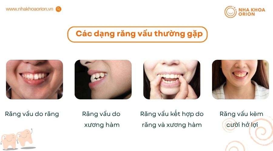 Răng vẩu được chia th&agrave;nh nhiều dạng dựa tr&ecirc;n nguy&ecirc;n nh&acirc;n g&acirc;y ra