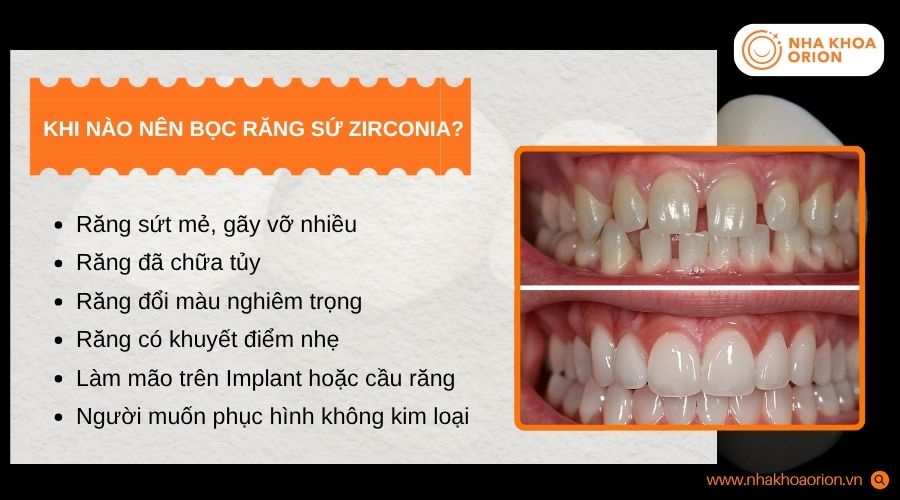 Răng sứ Zirconia được chỉ định cho nhiều trường hợp phục h&igrave;nh kh&aacute;c nhau