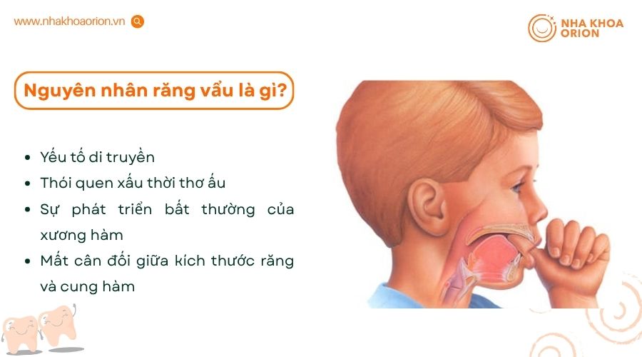 Răng vẩu c&oacute; thể xuất ph&aacute;t từ nhiều nguy&ecirc;n nh&acirc;n kh&aacute;c nhau