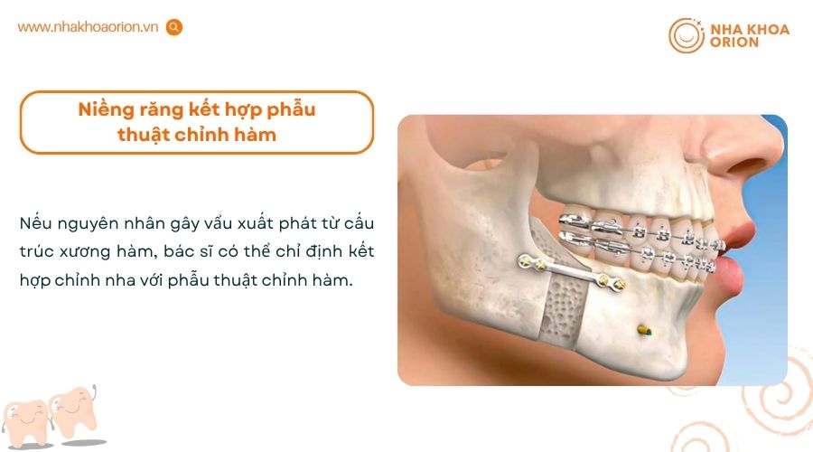 Niềng răng kết hợp chỉnh h&agrave;m thường được chỉ định cho c&aacute;c trường hợp vẩu do xương h&agrave;m