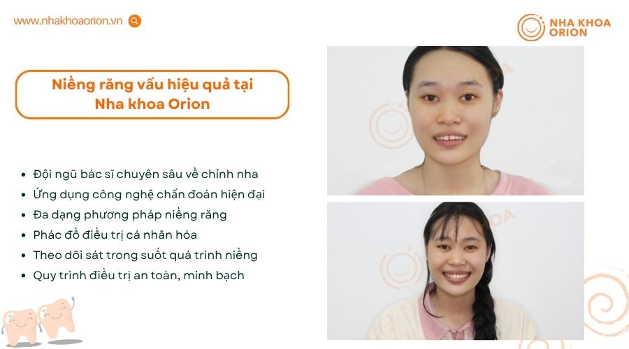 Nha khoa Orion l&agrave; địa chỉ niềng răng an to&agrave;n với b&aacute;c sĩ chuy&ecirc;n m&ocirc;n v&agrave; c&ocirc;ng nghệ hiện đại