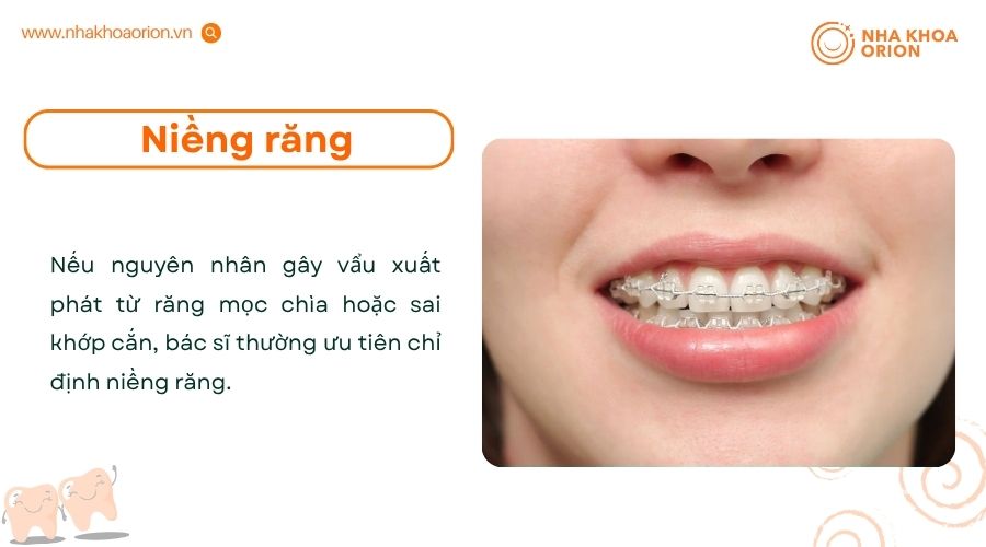 Niềng răng l&agrave; phương ph&aacute;p điều trị hiệu quả đối với c&aacute;c trường hợp răng vẩu do răng