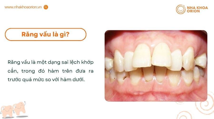 Răng vẩu l&agrave; một dạng sai khớp cắn phổ biến trong nha khoa