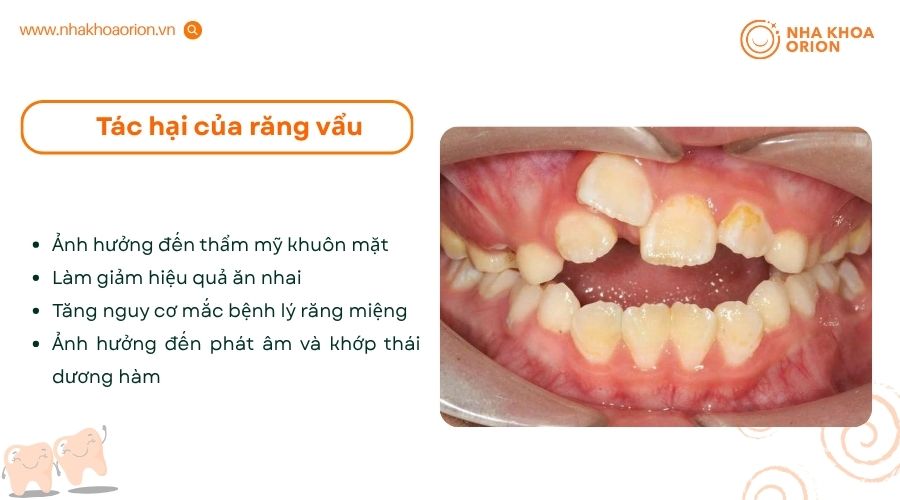 Răng vẩu ảnh hưởng đến thẩm mỹ, ăn nhai v&agrave; sức khỏe răng miệng