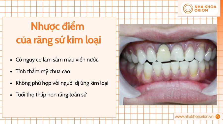 Khung kim loại có thể gây đen viền nướu, giảm thẩm mỹ và kích ứng mô mềm