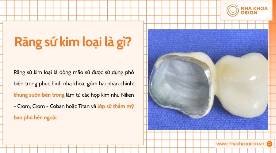 Răng sứ kim loại gồm khung hợp kim bên trong và lớp sứ thẩm mỹ phủ ngoài