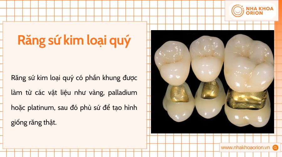 Răng sứ kim loại quý chống oxy hóa tốt, bền lâu nhưng có chi phí cao