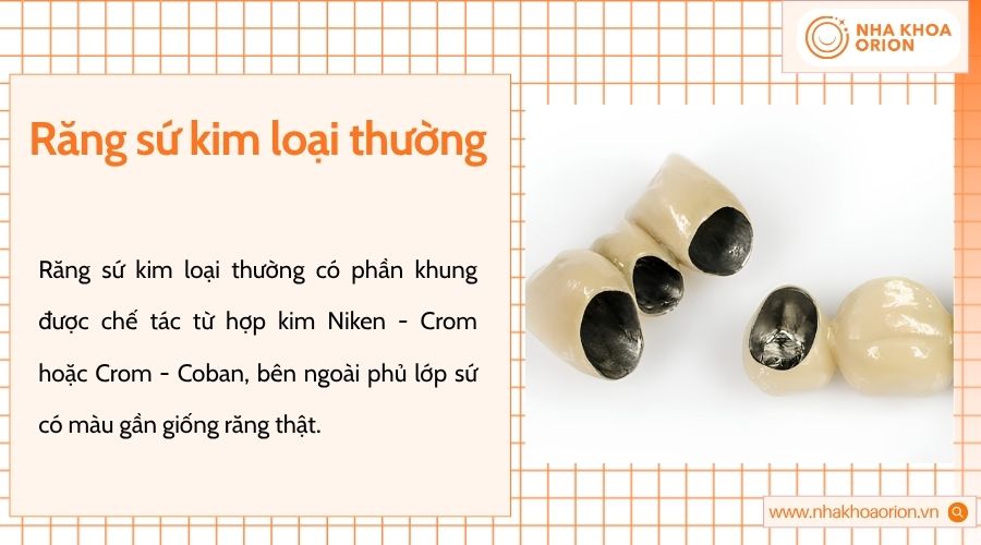 Răng sứ kim loại thường có chi phí thấp, chịu lực tốt nhưng thẩm mỹ còn hạn chế