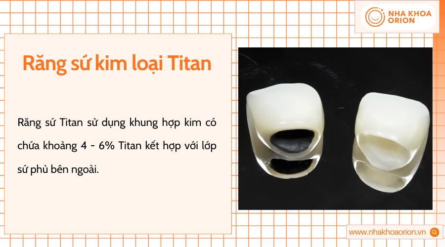 Răng sứ Titan nhẹ, bền, tương thích tốt hơn nhưng vẫn có nguy cơ đen viền nướu