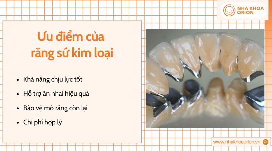 Răng sứ kim loại hỗ trợ ăn nhai, bảo vệ mô răng và tiết kiệm chi phí phục hình