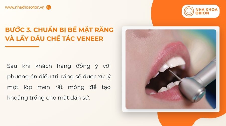 Răng được chuẩn bị để mặt dán sứ đạt độ ôm khít tối ưu