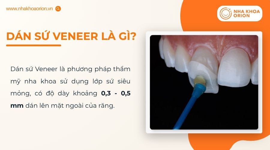 Dán sứ Veneer giúp cải thiện thẩm mỹ và bảo tồn tối đa răng thật