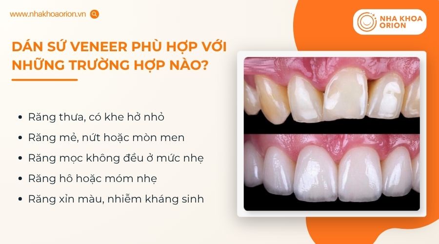 Dán sứ Veneer phù hợp với nhiều khuyết điểm răng ở mức nhẹ