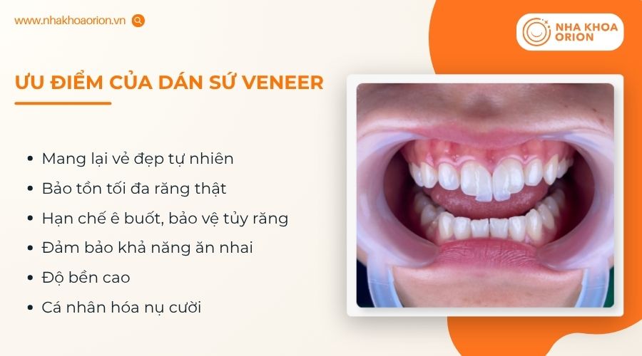 Dán sứ Veneer mang lại nhiều lợi ích về thẩm mỹ và chức năng