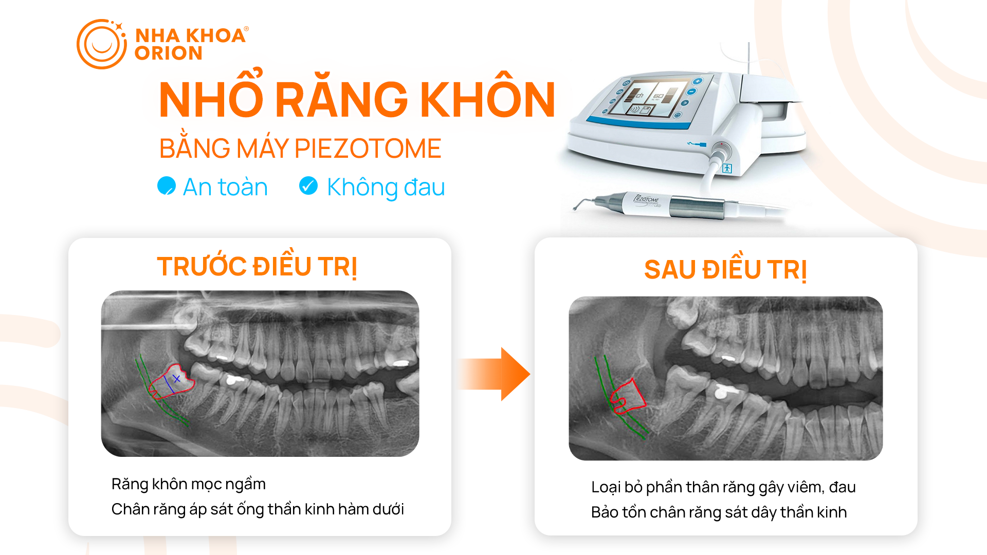 Nhổ răng kh&ocirc;n s&aacute;t ống d&acirc;y thần kinh bằng phương ph&aacute;p Coronetomy kết hợp với m&aacute;y Piezotome 