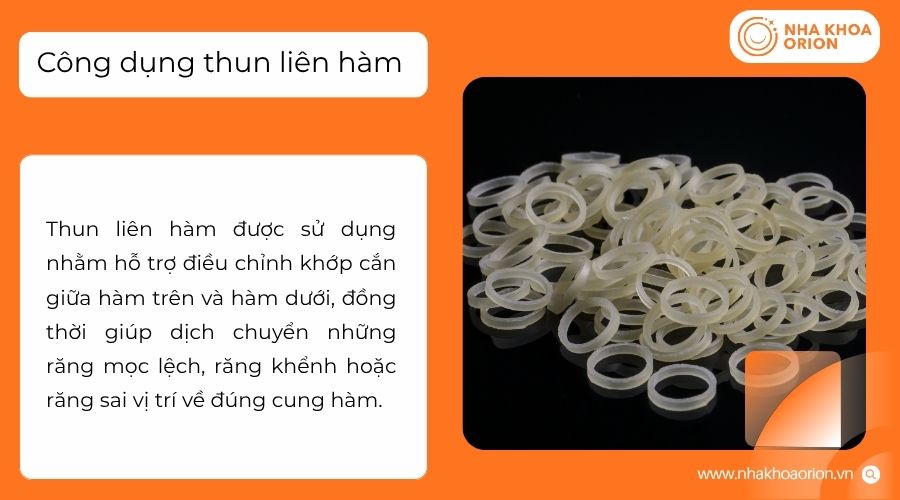 Thun li&ecirc;n h&agrave;m tạo lực k&eacute;o giữa hai h&agrave;m để hỗ trợ điều chỉnh khớp cắn