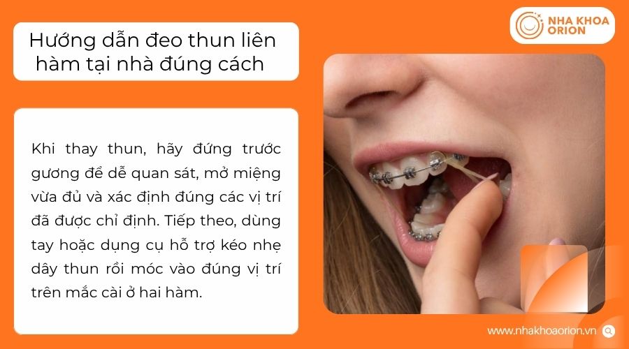 Đeo thun đ&uacute;ng vị tr&iacute; gi&uacute;p duy tr&igrave; lực k&eacute;o v&agrave; n&acirc;ng cao hiệu quả chỉnh nha