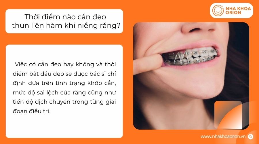 Thời điểm đeo thun li&ecirc;n h&agrave;m phụ thuộc v&agrave;o kế hoạch điều trị của từng người